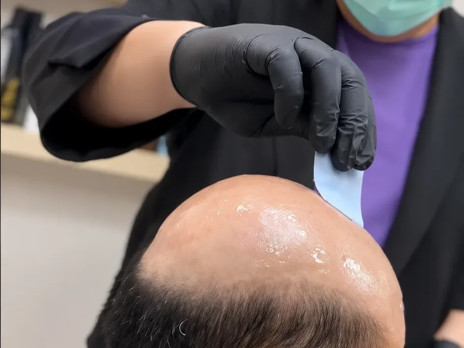 ช่างของร้านวิกผมผู้ชาย Wewigs Pro สวมถุงมือ ทากาวน้ำลงบนหนังศีรษะของลูกค้าชายที่โกนแล้ว ก่อนวางชิ้นผมเสริม