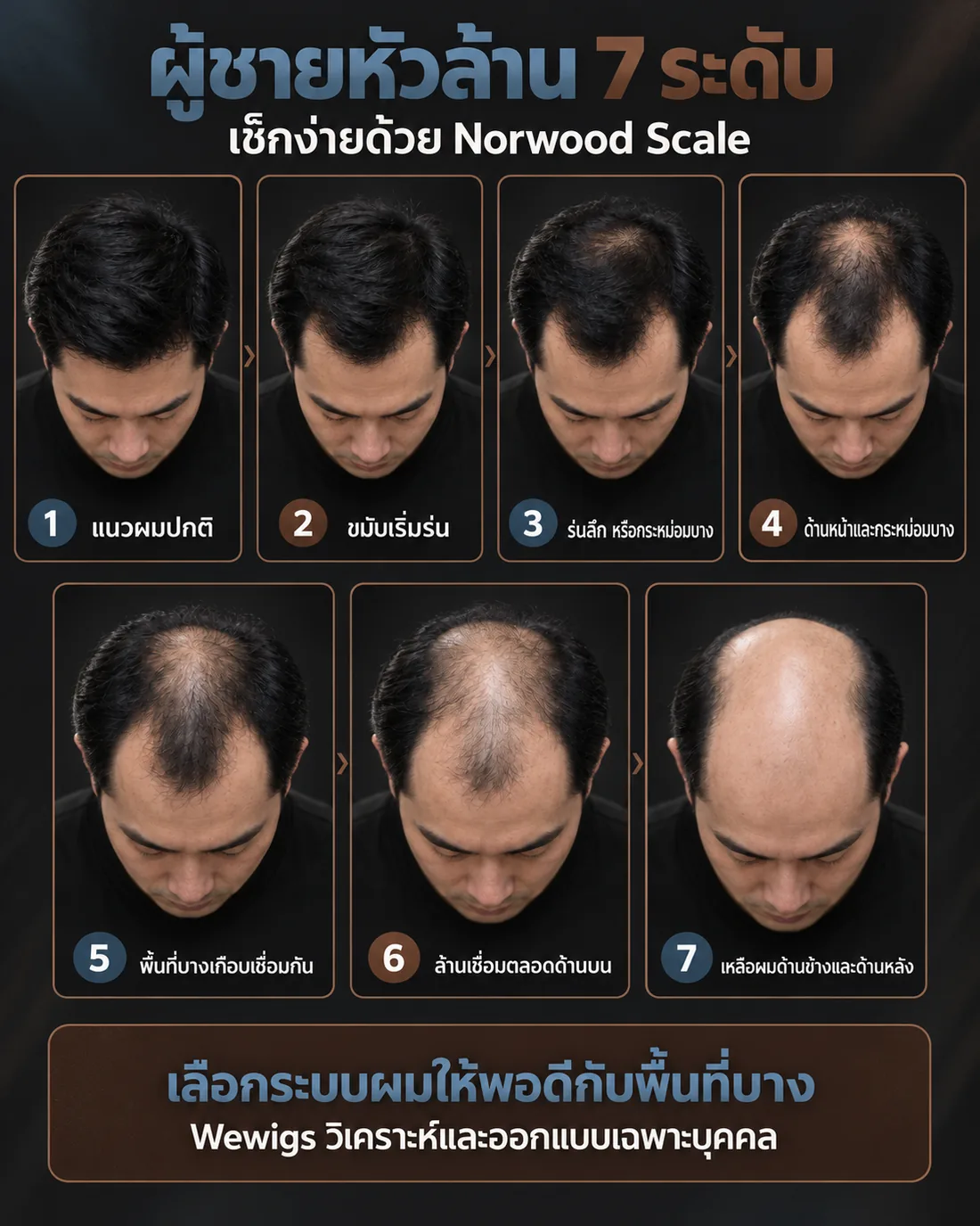 ภาพเทียบระดับผมบางและหัวล้านในผู้ชาย 7 ระดับตาม Norwood Scale ตั้งแต่แนวไรผมปกติ ขมับร่น กระหม่อมบาง ไปจนถึงล้านเหลือผมเฉพาะด้านข้างและด้านหลัง